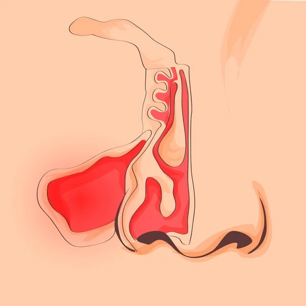 Anatomie nosu a krku. Struktura lidského orgánu. Ilustrace sinusitida, rinitis, bolest v nose — Stockový vektor