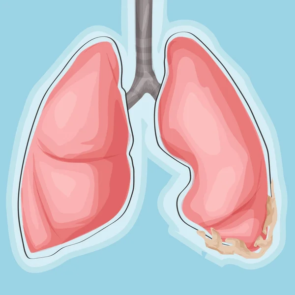 肺癌、癌。医学のベクトル図です。漫画のスタイル — ストックベクタ