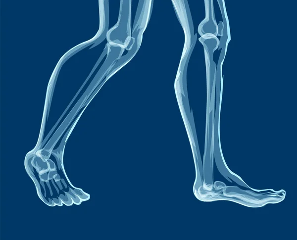 Tulang kaki manusia, X-ray. Ilustrasi vektor mecial . - Stok Vektor