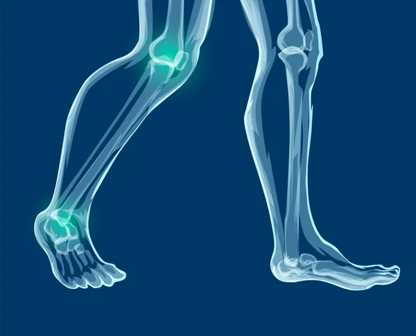 Huesos humanos en las piernas, radiografías. Ilustración del vector Mecial . — Vector de stock