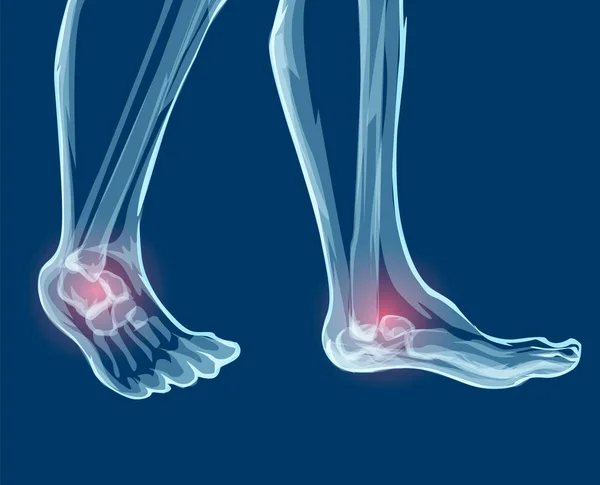 Nogi ludzkie kości, promieniowanie rentgenowskie. Ilustracja wektorowa Mecial. — Wektor stockowy