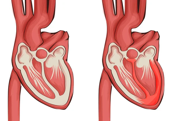 Vector illustration of heart healthy and diseased myocarditis — Stock Vector