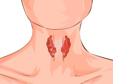Hipertiroidi ve bir kadın gösterilen nefes borusu. Tıbbi kavramı. İnsan anatomisi. Vektör çizim.