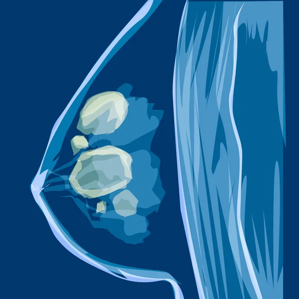 Εικονογράφηση ιατρική φορέα καρκίνου του μαστού. Ανατομία της γυναίκας νόσου — Διανυσματικό Αρχείο
