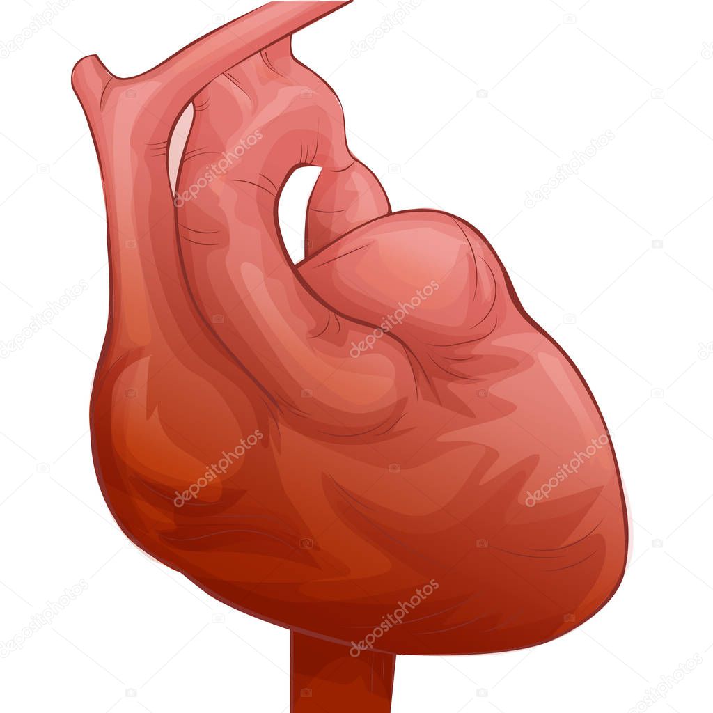 Heart disease with coartation of aorta. Myocardial infarction or heart attack concept. Medical illustration cardiology