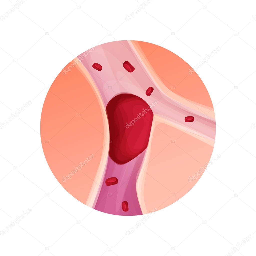 Blocked blood vessel - artery with blood clot realistic vector illustration isolated background