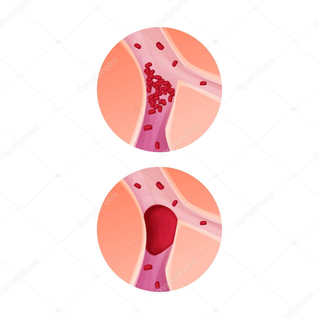 Blocked blood vessel - artery with blood clot realistic vector illustration isolated background