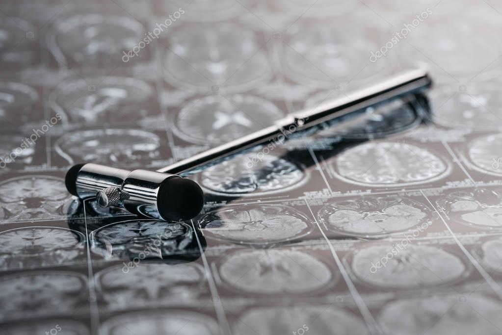 Close up view of reflex hammer on x-ray picture