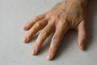 İnsan eli ve parmaklarında egzama dermatiti var. Deri soyma, el temizliği, gri modern arka plan. El derisi iltihabı, egzama. Parmak problemi, alerji. Metnin için boşluk kopyala.