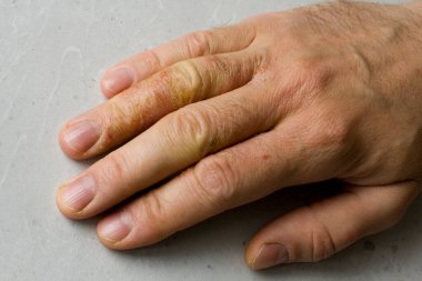 İnsan eli ve parmaklarında egzama dermatiti var. Deri soyma, el temizliği, gri modern arka plan. El derisi iltihabı, egzama. Parmak problemi, alerji. Metnin için boşluk kopyala.