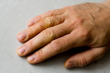 İnsan eli ve parmaklarında egzama dermatiti var. Deri soyma, el temizliği, gri modern arka plan. El derisi iltihabı, egzama. Parmak problemi, alerji. Metnin için boşluk kopyala.