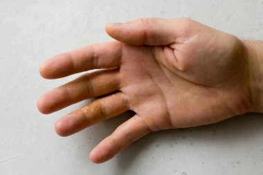 İnsan eli ve parmaklarında egzama dermatiti var. Deri soyma, el temizliği, gri modern arka plan. El derisi iltihabı, egzama. Parmak problemi, alerji. Metnin için boşluk kopyala.