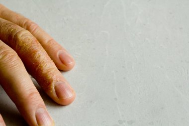 İnsan eli ve parmaklarında egzama dermatiti var. Deri soyma, el temizliği, gri modern arka plan. El derisi iltihabı, egzama. Parmak problemi, alerji. Metnin için boşluk kopyala.