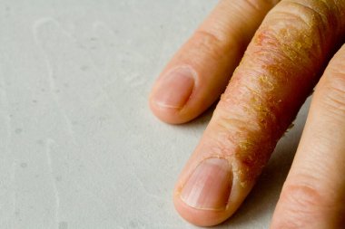 İnsan eli ve parmaklarında egzama dermatiti var. Deri soyma, el temizliği, gri modern arka plan. El derisi iltihabı, egzama. Parmak problemi, alerji. Metnin için boşluk kopyala.