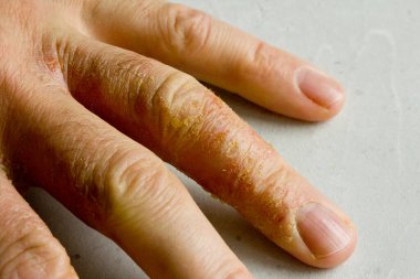İnsan eli ve parmaklarında egzama dermatiti var. Deri soyma, el temizliği, gri modern arka plan. El derisi iltihabı, egzama. Parmak problemi, alerji. Metnin için boşluk kopyala.