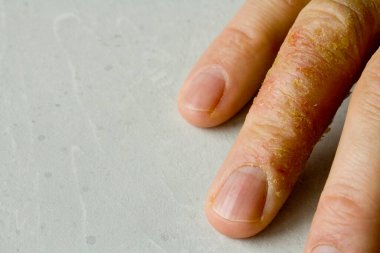 İnsan eli ve parmaklarında egzama dermatiti var. Deri soyma, el temizliği, gri modern arka plan. El derisi iltihabı, egzama. Parmak problemi, alerji. Metnin için boşluk kopyala.