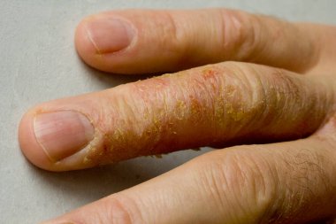 İnsan eli ve parmaklarında egzama dermatiti var. Deri soyma, el temizliği, gri modern arka plan. El derisi iltihabı, egzama. Parmak problemi, alerji. Metnin için boşluk kopyala.