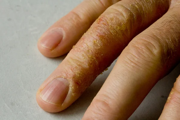 Close Van Eczeem Dermatitis Hand Vingers Van Mens Huidschilfering Desquamatie — Stockfoto