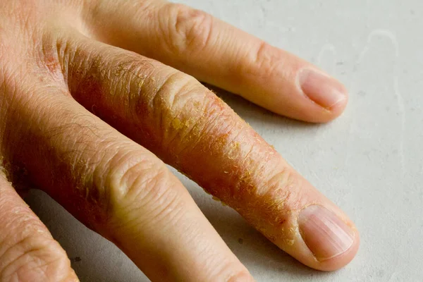 Closeup Eczema Dermatitis Man Hand Fingers Skin Peeling Desquamation Hand — Stock Photo, Image