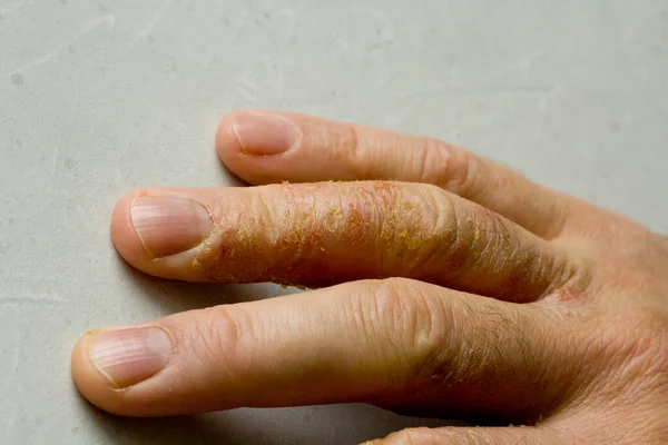 Крупный План Дерматита Экземы Руках Пальцах Человека Кожа Пилинг Десквамация — стоковое фото