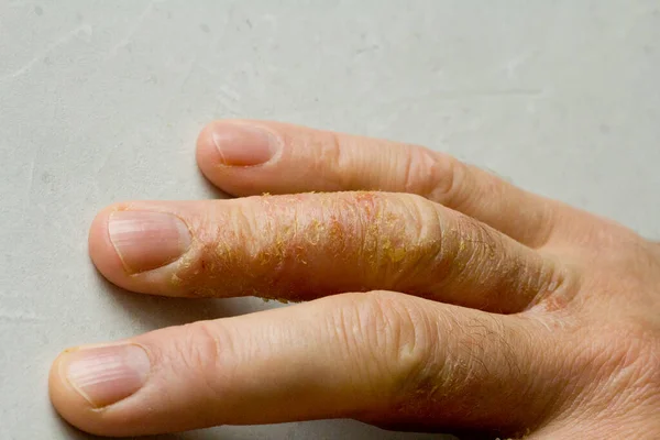 Closeup of Eczema Dermatitis on man hand and fingers. Skin peeling,desquamation of hand, gray modern background. Hand dermatitis, eczema. Finger problem, allergy. Copy space for your text.