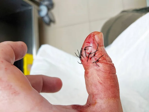 Повреждение Большого Пальца Левой Руки Сшивание Пальца После Пореза Острым — стоковое фото