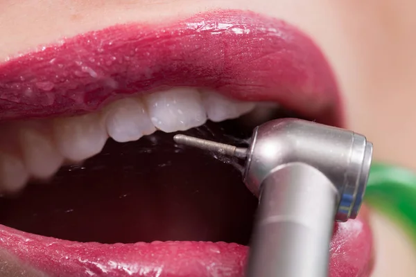 Tannlege som kurerer en kvinnelig pasient – stockfoto