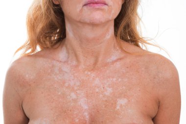 Cildindeki vitiligo noktalarının ayrıntıları