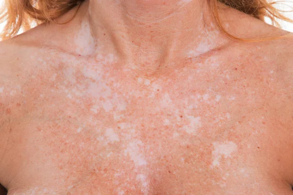 Cildindeki vitiligo noktalarının ayrıntıları