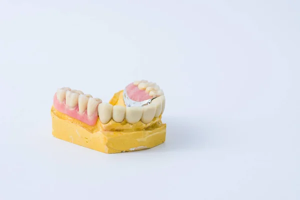歯科補綴物モデル — ストック写真
