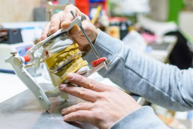 Bir diş protez çalışma