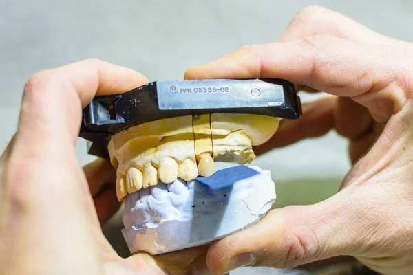 Biting test with prosthesis molds — Stock Photo, Image