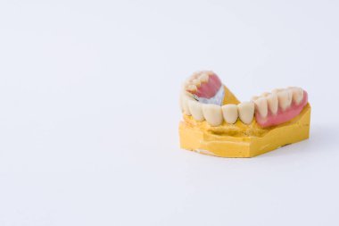 Bir kalıp üzerinde Diş Protez