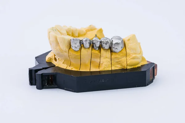 Metal teeth for prosthesis — Stock Photo, Image