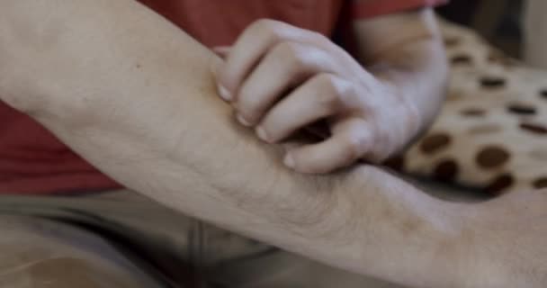 Мужчина чешет руку из-за дерматита и зуда. Закрыть — стоковое видео
