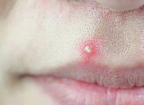 Virüslü Püstüllü akne yüz, sivilce tarih seçici odak