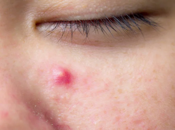 De besmette pustulous acne op het gezicht, selectieve aandacht op acne — Stockfoto