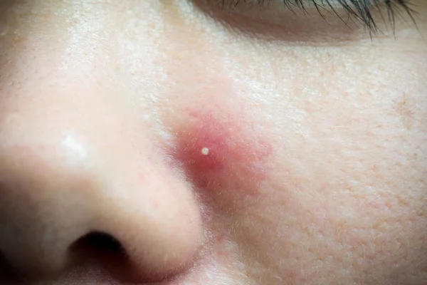 De besmette pustulous acne op het gezicht, selectieve aandacht op acne — Stockfoto
