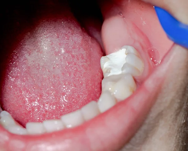 Макро зуба с амальгамной начинкой — стоковое фото