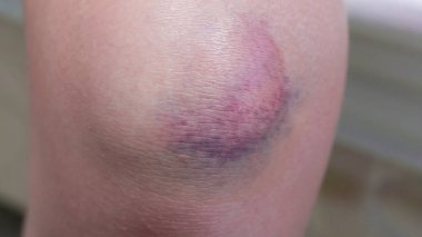 Genç kadının diz yaralanma çürük.