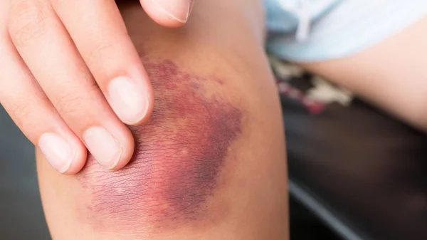 Yaralı diz bir çürük ile parmaklarını iyileştirici bir merhem ile yakından bir kız losyonları