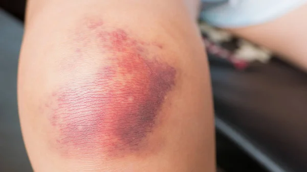 瘀伤的年轻女人的膝盖上 — 图库照片