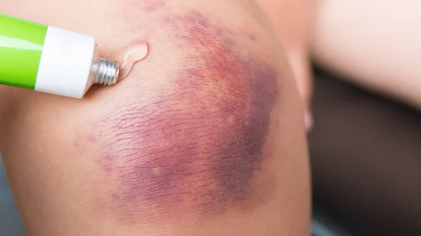 Yaralı diz bir çürük ile parmaklarını iyileştirici bir merhem ile yakından bir kız losyonları