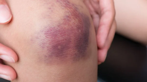 瘀伤的年轻女人的膝盖上 图库照片