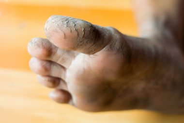 Ayakları üzerinde çatlaklar yakın çekim