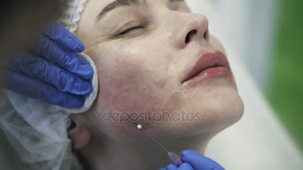 Cosmetican inserindo agulha na bochecha da mulher e removendo-a — Vídeo de Stock