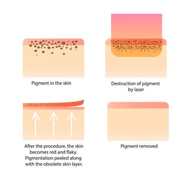 Kozmetik lazer. Dövme, çiller, eski karanlık noktalar pigment kaldırma yordamı