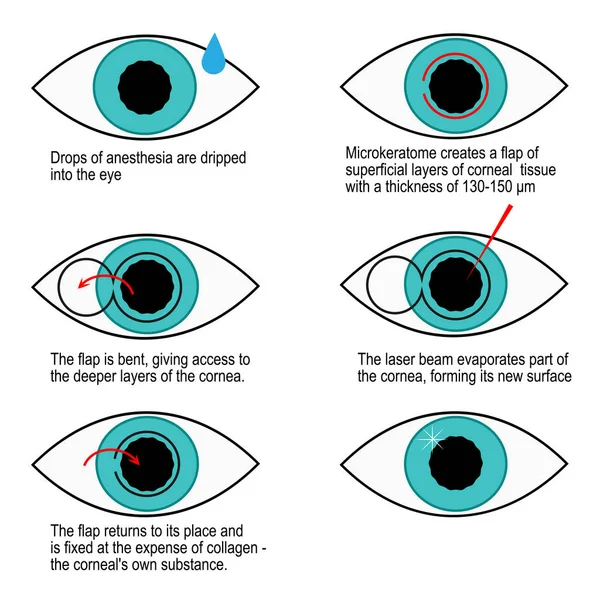 Prosedur koreksi laser tahap demi tahap penglihatan. Infografis - Stok Vektor
