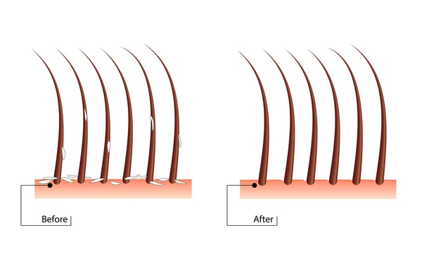 O problema do cabelo da caspa. Antes e depois do procedimento. Resultado do tratamento scurf — Vetor de Stock