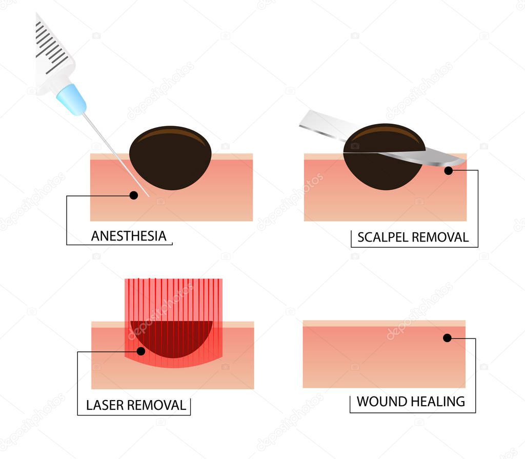 laser removal of moles. A phased scheme of the procedure.